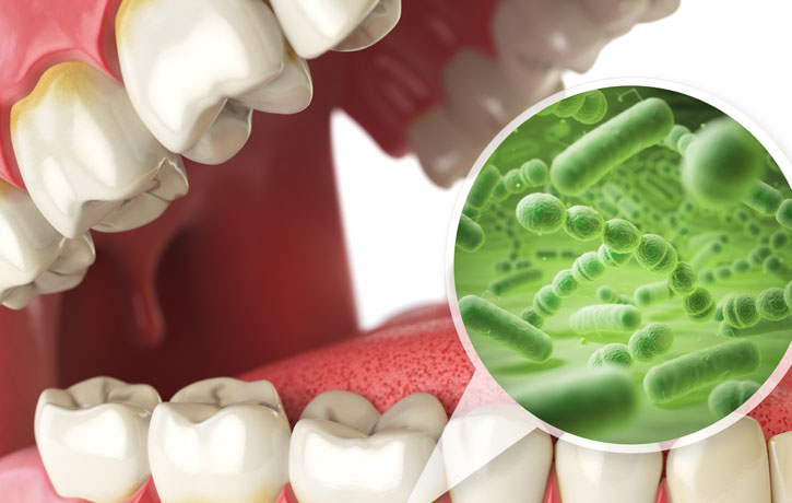 Stages of Gum Disease Clermont, FL